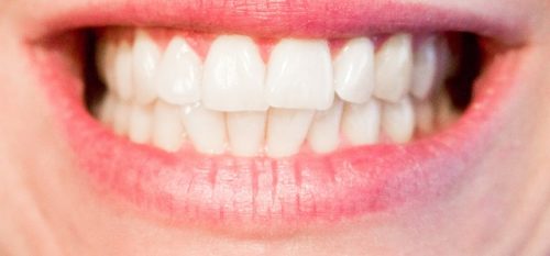 7 Reasons Why You Need Straight Teeth Now