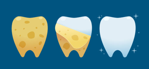 Prevent Yellow Teeth with these 5 Tips