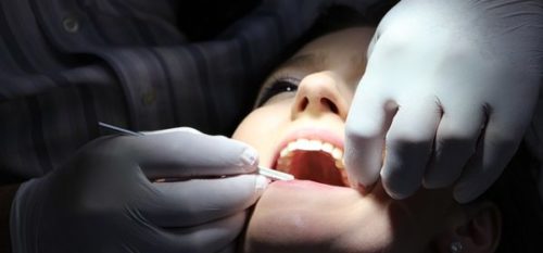 Dental Implant Abutment: What Is It?