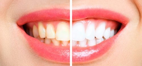 How White Can Teeth Be?