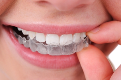 teeth straightening with invisalign