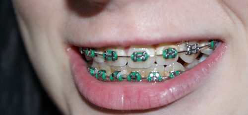6 Ways to Get Ready for Metal Braces