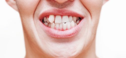 What’s Wrong With Crooked Teeth?