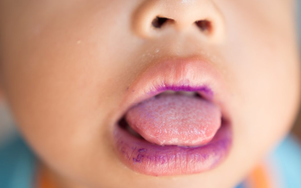 What is hand-foot-and-mouth disease?