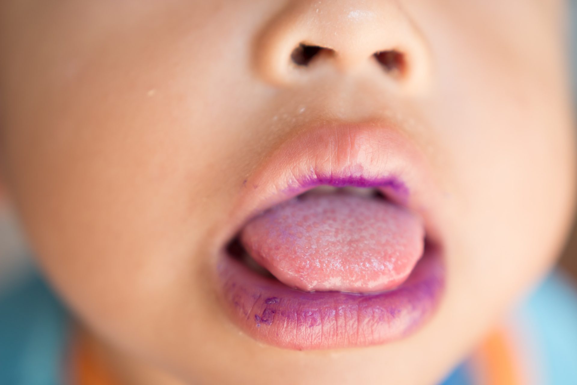 What is hand-foot-and-mouth disease?