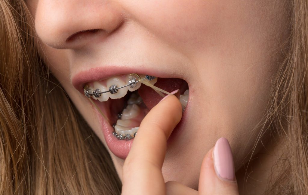 Ever wondered why are there rubber bands on braces? They're actually very important for your orthodontic treatment plan. Find out why.