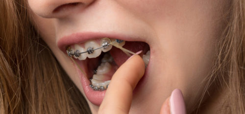 Why are There Rubber Bands on Braces?
